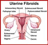 A case study — regression of uterine fibroids