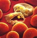 Malarial fever and its Āyurvedic management