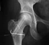 A journey though pain